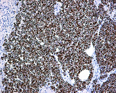 CK20 positivity: perinuclear dot-like staining ×20.