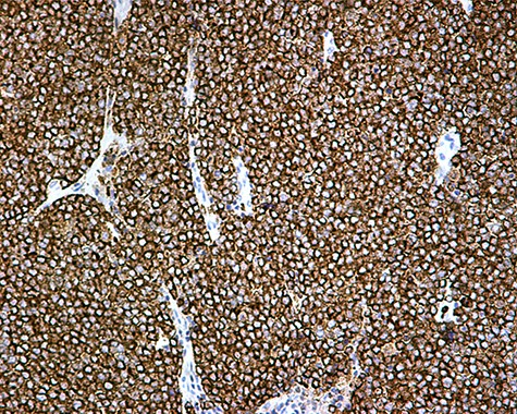 Chromogranin A positivity ×20.