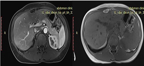 Axial T1 weighted images pre- and post-IV contrast sequences demonstrate extrahepatic fatty lesion in the anterior perihepatic space adjacent to the falciform ligament.