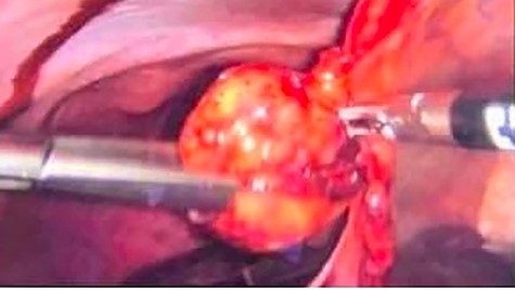 Laparoscopic view of infarcted lipoma during excision.
