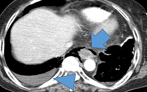A thoracoabdominal contrast-enhanced computed tomography showed a poorly contrasted area and mediastinal emphysema in the middle and lower esophagus (arrows). Right pneumothorax and pleural effusion are present (arrowhead).