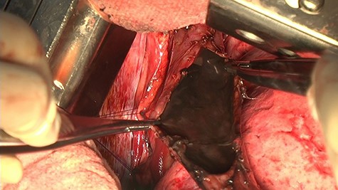 The thoracic cavity was highly contaminated, with a 25 mm perforation of the central thoracic esophagus, and the esophageal mucosa was discolored black all around.