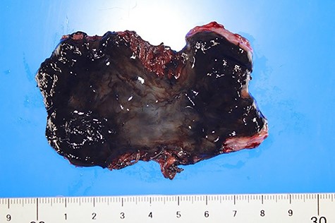 The mucous membrane of the resected esophagus was black in all areas. No malignant findings were found.