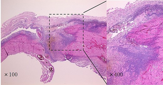 Histopathological findings showed that the esophageal mucosa was ulcerated and necrotic, with perforation in multiple locations. There was a strong lymphocytic infiltration in the submucosa.