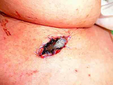 The esophageal mucosa of the esophageal fistula was also blackened.