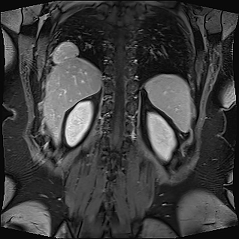 Multilobulated solid lesion measuring 5.7 × 2.9 × 3.6 cm seen in the right hemithorax adjacent to a right costophrenic recess, closely abutting the liver and appears to be continuous with the liver parenchyma with a narrow pedicle/area of contact.