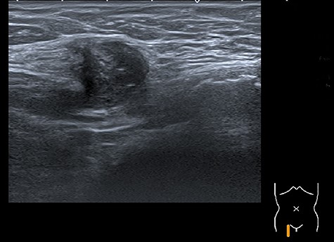 Image of the inguinal ultrasound that shows an inhomogeneous round mass surrounded by subcutaneous fat tissue.