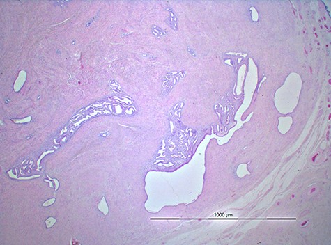 Image of histopathology shows a well-circumscribed lesion composed of foci of benign endometrial glands and endometrial stroma surrounded fat and connective tissue.