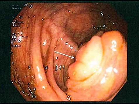 Colonoscopic image demonstrating cecal fullness with prolapsed ileocecal valve (arrow).