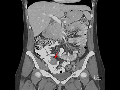 Coronal CT scan image showing mass (arrow) at ileocecal valve.