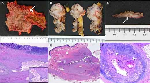 (A) Gross pathological assessment of ileocolic region demonstrates macroscopic nodularity (arrow) at the region of the ileocecal valve and appendix difficult to identify. (B) Gross pathological view after serial sagittal sectioning at the ileocecal valve demonstrates a significant infiltrative, fibrotic, mass-like effect explaining the prolapsing area witnessed on endoscopy. (C) Gross pathological section from the ileocecal region shows macroscopic evidence of a large submucosal endometrial implant (arrow) within the wall of the bowel. (D) Low-power histopathologic examination showing colonic mucosa with endometriosis in the underlying wall. Higher power microscopy (inset) shows a gland lined by benign endometrial-type epithelium with supporting endometrial stroma, containing blood and hemosiderin. (E) Histopathologic examination demonstrating cecal endometrial mass infiltrating the muscularis propria and submucosa (arrow) causing smooth muscle hyperplasia and hypertrophy, and (F) glandular endometrial tissue within a pericolonic lymph node (arrows).