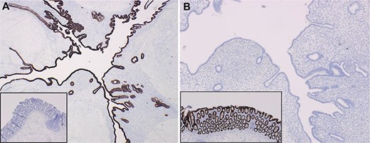 Targeted IHC staining facilitated differentiation of endometrial implants from colonic epithelium (insets) using (A) CK7+ and (B) CDX2+ staining.