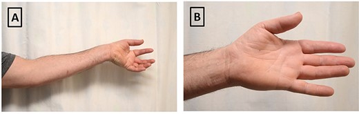 Clinical photographs of preoperative examination. (A) Patient attempting to make an ‘O-sign’ illustrating inability to use flexor pollicis longus and flexor digitorum profundus/flexor digitorum superficialis of index finger; (B) inability to fully abduct left thumb and demonstration of thenar muscle wasting of affected hand.