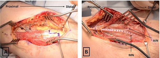 Intraoperative photograph demonstrating Z-lengthening of left-sided PT and revealing median and AIN nerve in the volar forearm dotted (A) before PT release and (B) after PT release. AIN, anterior interosseous nerve; MN, median nerve; PT, pronator teres.