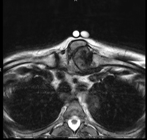 MRI sternoclavicular joint showing lobulated calcified and necrotic mass of 3.9 cm by 4.3 cm on the left SCJ causing a mass effect on adjacent structures; anteriorly the mass is bordered by the sternocleidomastoid muscle and dorsally by the sternohyoid muscle.