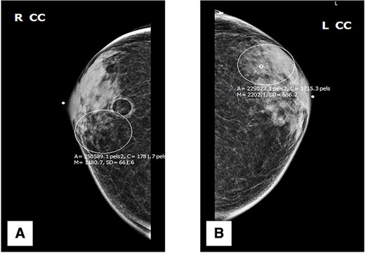Craniocaudal (CC) mammography: (A) right breast; (B) left breast.