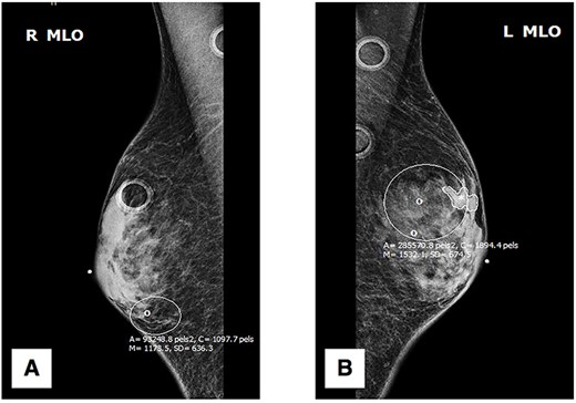 Mediolateral oblique (MLO) mammography: (A) right breast; (B) left breast.