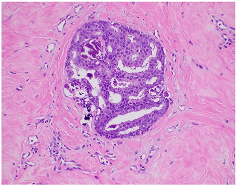 Pathologic microscopy of left breast ductal carcinoma in situ.