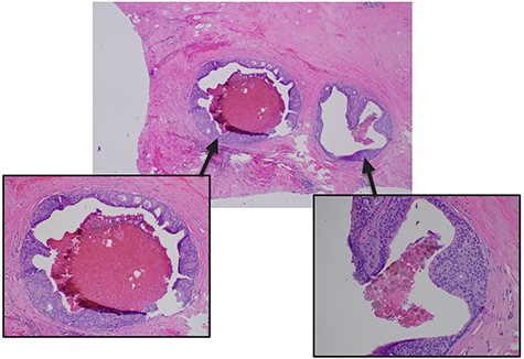 Pathologic microscopy of right breast ductal carcinoma in situ with magnified images highlighting absence of local invasion.