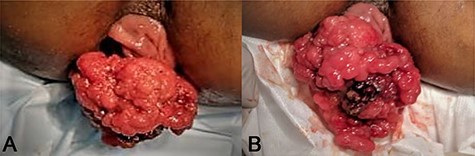 The patient on presentation had a large prolapsing polypoidal mass per rectum, dragging along with it the anterior wall of rectum. The bleeding was almost watery and there was an area of injury which was due to finger insinuation for reducing the mass. The base of the polyp was wide ~3 x 2 cm from the left antero-lateral wall of the rectum ~6–7cms from the anal verge after resection.