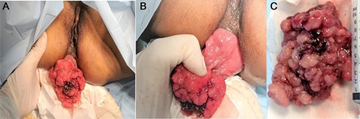 The intra-operative picture of before and after resection of the polyp which was ~10 x 12 cm in size. The finger insinuation injury is seen with clots.