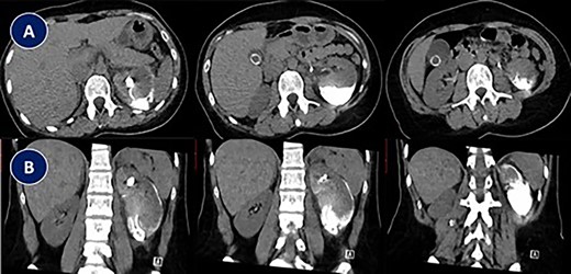 Abdominal CT scan showing complete misplacement of DJ stent into subcapsular renal space. (A) CT scan image (Axial). (B) CT scan image (Coronal).