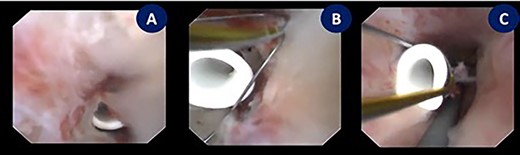 Endoscopic exploration revealing the tip of a subcapsular renal DJ stent intraparenchymal just behind the renal papilla, managed by using N-Gage from (Cook) in order to confront-capture the DJ stent tip. (A) Tip of a DJ stent intraparenchymal. (B and C) N-Gage basket capturing the tip of a DJ stent.