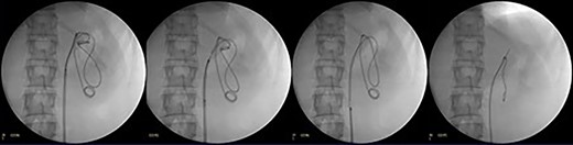 Fluoroscopic images showing DJ stent removal in steps.