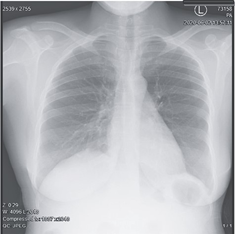 Normal chest X-ray.