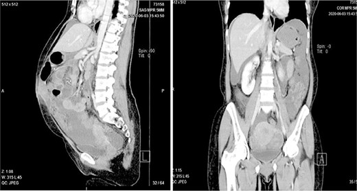 Computed tomography showing a complex cystic mass arising from left ovary with heavy mesentery metastasis.