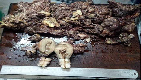 Hysterectomy specimen with ovarian complex mass and extensive mesentery involvement.