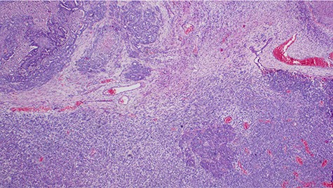 Histopathology of the tumor showing malignant epithelial and sarcomatous elements, hematoxylin and eosin, ×40 magnifications.