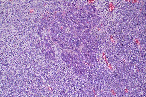 Histopathology of the tumor with malignant epithelial and sarcomatous elements, hematoxylin and eosin, ×100 magnifications.
