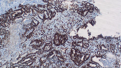 p53 immunohistochemistry highlighting tumor cell positivity on both epithelial and stromal elements, ×40.