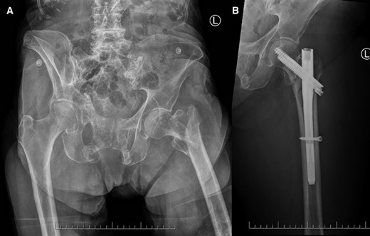 Frontal radiographs demonstrating (A) the comminuted left intertrochanteric hip fracture with separate lesser and greater trochanteric fragments (left), and (B) the comminuted left intertrochanteric hip fracture treated with internal fixation with proximally and distally locked short cephalomedullary nails (right).