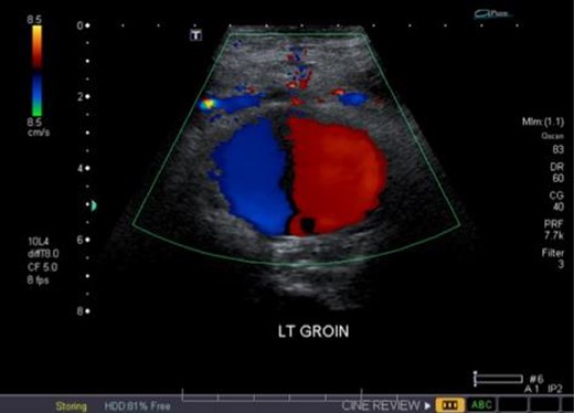 Duplex ultrasound overlying the left groin demonstrating bidirectional flow in the pseudoaneurysm (i.e. ‘yin-yang’ sign).