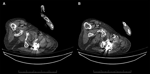 Contrast-enhanced arterial phase axial computed tomographic (CT) images overlying the left hip demonstrating (A) hyperdense material anterior to the left hip in keeping with hematoma (left), and (B) hyperdense material that corresponds to the pseudoaneurysm, which is supplied by a small DFA branch coursing anteriorly and abutting a sharp osseous fragment (right).
