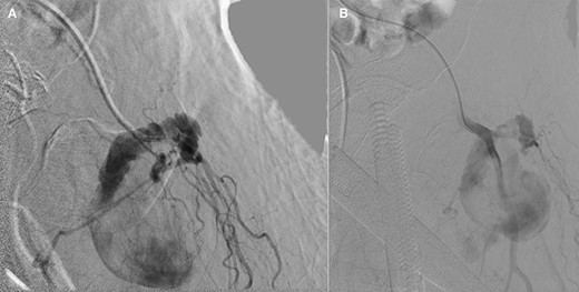 (A and B): Frontal digitally subtracted angiography via a diagnostic catheter positioned in the proximal left DFA demonstrating a large pseudoaneurysm originating from a small DFA branch. The long, narrow and lobulated pseudoaneurysm neck can be see coursing along the cranial aspect of the pseudoaneurysm.