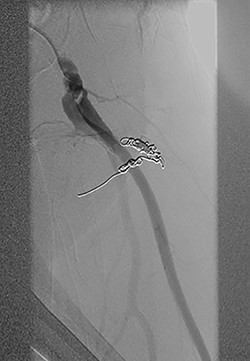 Postcoil embolization digitally subtracted angiography via a diagnostic catheter positioned in the left DFA demonstrating adequate embolization of the injured small DFA branch with complete exclusion of the pseudoaneurysm.