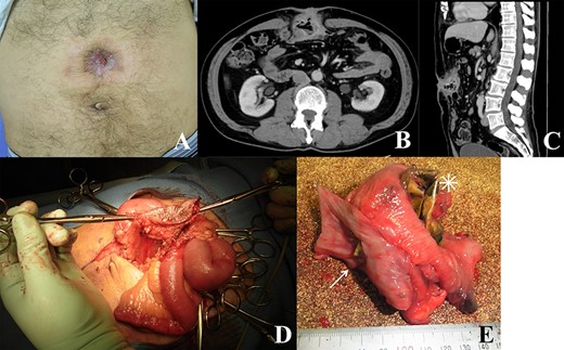 (A) Image of the patient’s abdomen before surgery. Reddish wound and fistula; (B and C) contrast-enhanced CT scan showing recurrence of abdominal incisional hernia with intestinal wall thickening; (D) intraoperative findings; skin, abdominal wall and intestines forming a mass; (E) excised specimen; mesh migrating through the small intestinal wall (asterisk) and its corner penetrating the colon (arrow).