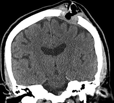 Head CT without contrast (coronal plane) showing a 3.3-cm lytic lesion of the left parietal calvarium with extension of soft tissue hyperdensity to the dural surface.