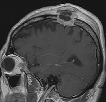 MRI brain T1 postcontrast view (sagittal plane) showing an avidly enhancing mass eroding through the left parietal bone and extending deep to the dura with scalp edema and thickening, in addition to smaller enhancing lesions of the frontal calvarium.