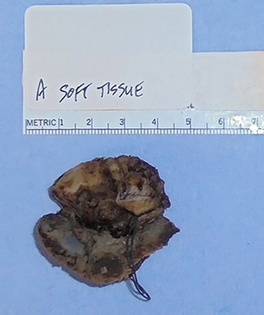 A 4.5-cm plasma cell myeloma made up of malignant plasma cells with large nucleoli positive for CD45, CD56, CD79a, CD138 and epithelial membrane antigen.