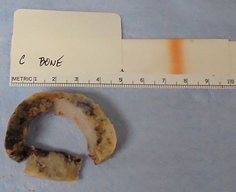 Excised portion of left parietal bone at the edge of the lytic lesion, containing patchy intramedullary sheets of malignant plasma cells with hemorrhage and necrosis.