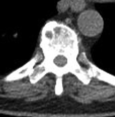Positron emission tomography/CT showing numerous foci of uptake involving the axial skeleton (thoracic vertebral and rib lesions noted in this image).