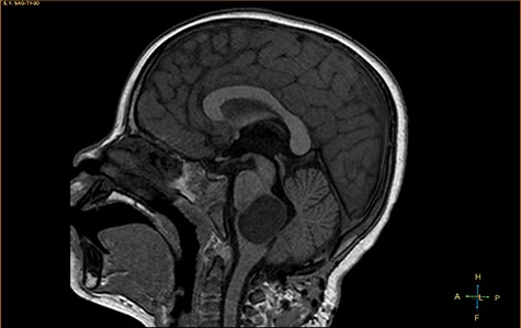 Sagittal T1-weighted image, revealing a hypointense mass positioned in the medulla oblongata.