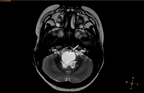 Axial T2-weighted image, showing a hyperintense, cystic mass inside the medulla oblongata. Exceptionally, the lesion appears to progress from extra-axial to intraparenchymal (arrow).