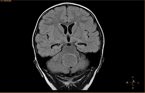 Coronal fluid-attenuated inversion recovery image, showing an isointense mass relative to the surrounding parenchyma.