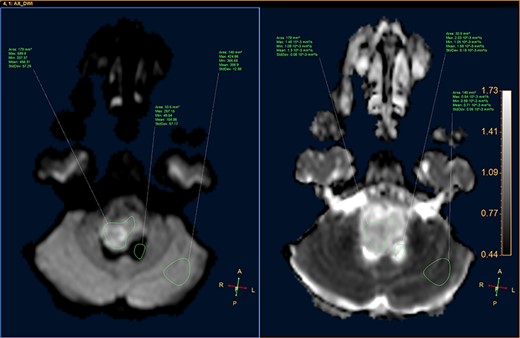DWI image and ADC map, showing the CSF, lesion and normal-appearing parenchyma.