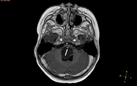 Axial T1-weighted image, with contrast agent, revealing a cystic mass, with a very small enhancing mural nodule (arrow).